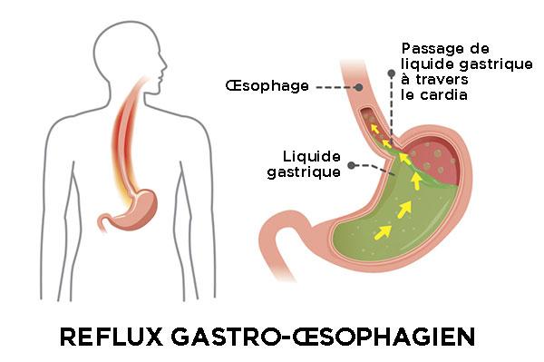 Reflux gastro-oesophagien - Docteur Rafaële Gerometta